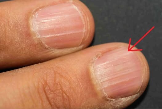 When you see these ridges on your nails after age 40, it’s an obvious warning – The Concealed Messages Behind Nail Appearances