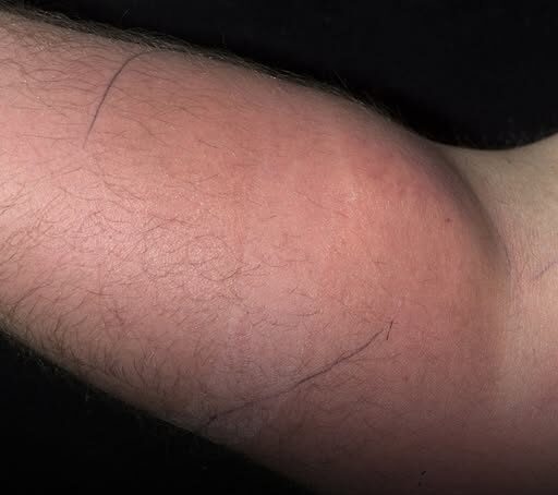 Man suffered horrifying side effects after injecting himself with own sperm to ‘cure back pain’