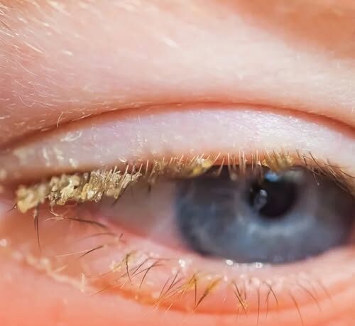 What yellow stuff in your eyes when you wake up actually is!