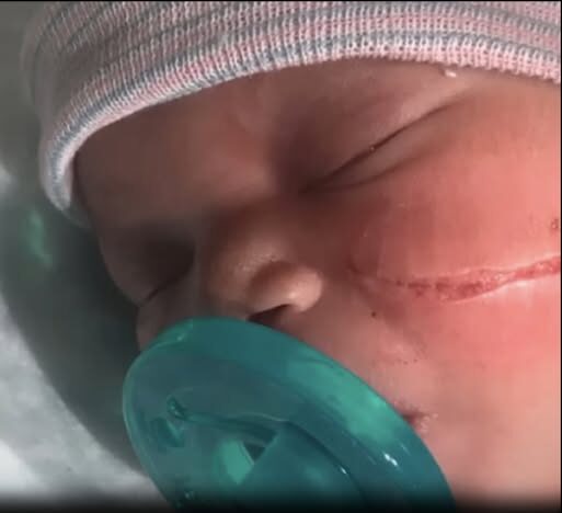 Newborn baby needs 13 stitches after surgeon ripped open her face during C-section