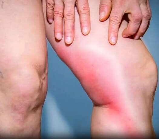 Your body warns you before a blood clot: 8 hidden signs you should never ignore
