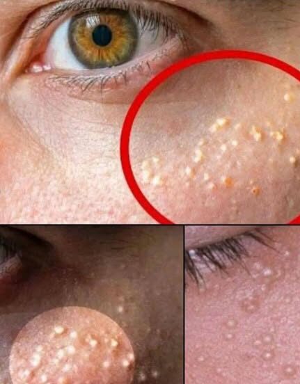 Tiny White Bumps on Your Face? Here’s What They Are—And How to Treat Milia Naturally and Safely at Home