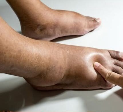 Swollen Hands & Feet?