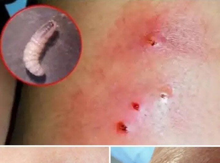 HT14. Larvae Found in Young Woman’s Body… How Did They Get There? (The Answer Will Horrify You)