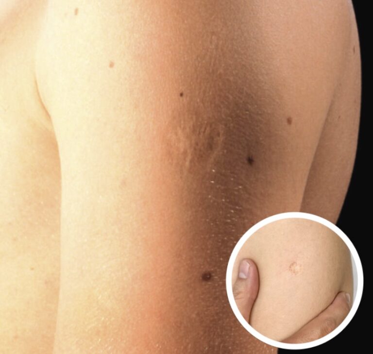 Here’s The Truth Behind This Scar On People’s Upper Left Arm