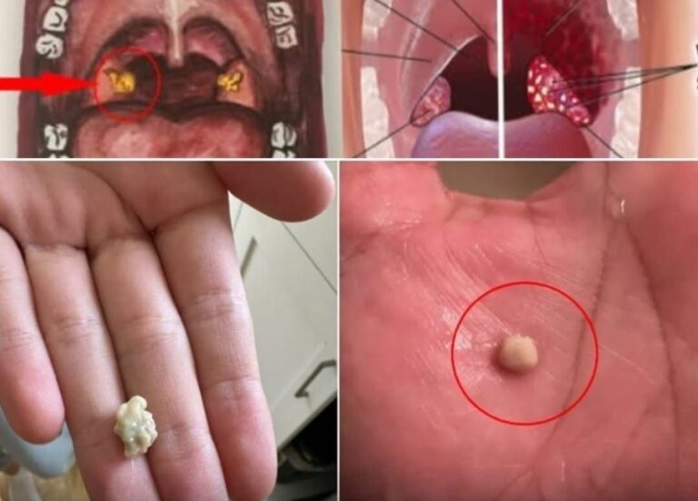 Here’s what you need to know about tonsil stones – the weird pimple-like growths in your throat