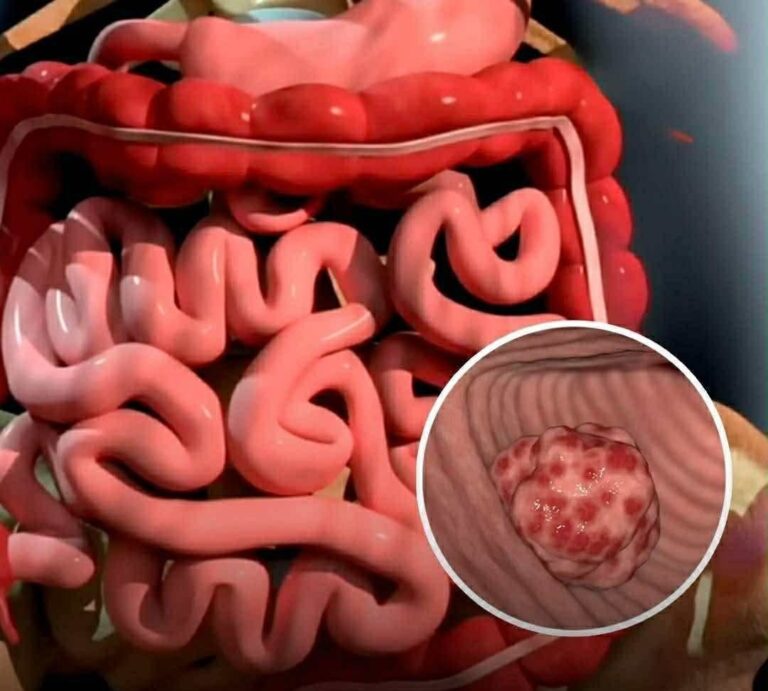 Striking simulation illustrates the progression of death from cancer
