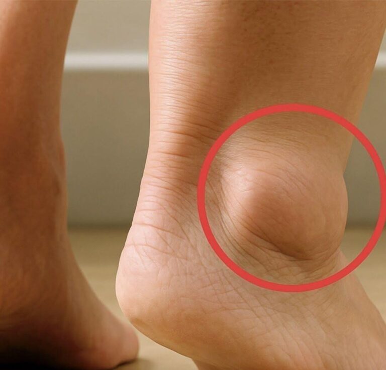 Swollen Legs: Understanding the Symptoms, Causes, and Treatments