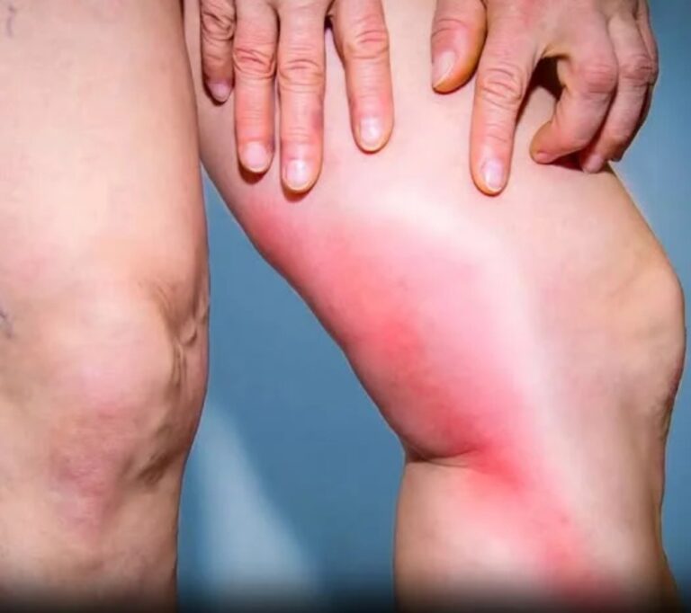 Your body warns you before a blood clot: 8 hidden signs you should never ignore