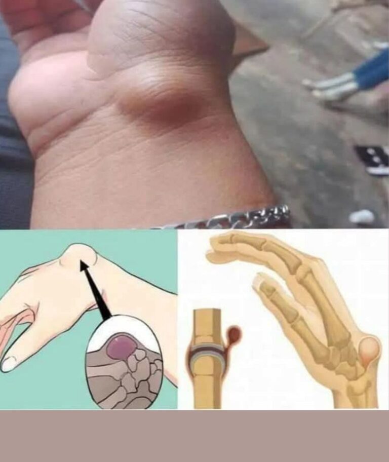 If You Get These Bruises on Your Body, It Might Mean Something Serious
