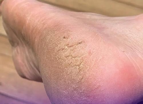 Pharmacist reveals wa.rning sign in heels of foot that could be symptom of serious condition