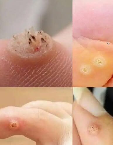 Be Very Careful: If You Notice This Skin Growth, It Could Be Serious