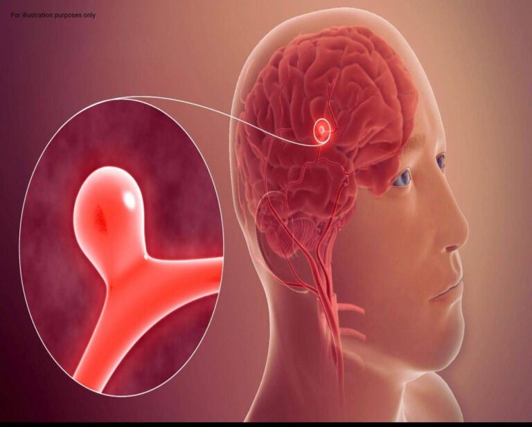 Aneurysm: Symptoms You Shouldn’t Ignore