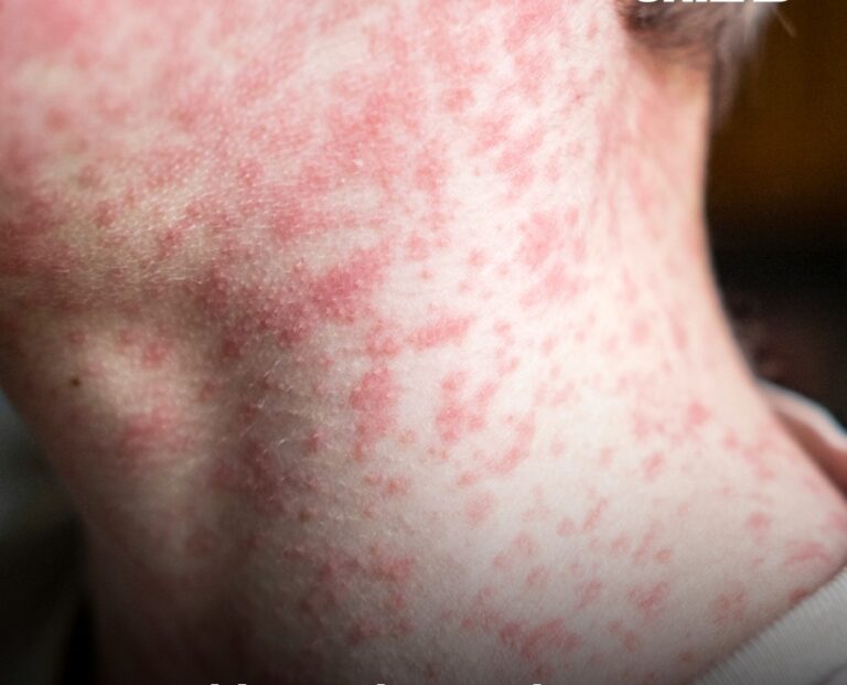 Everything to know about US measles outbreak as 2025 cases so far surpass numbers for whole of 2024