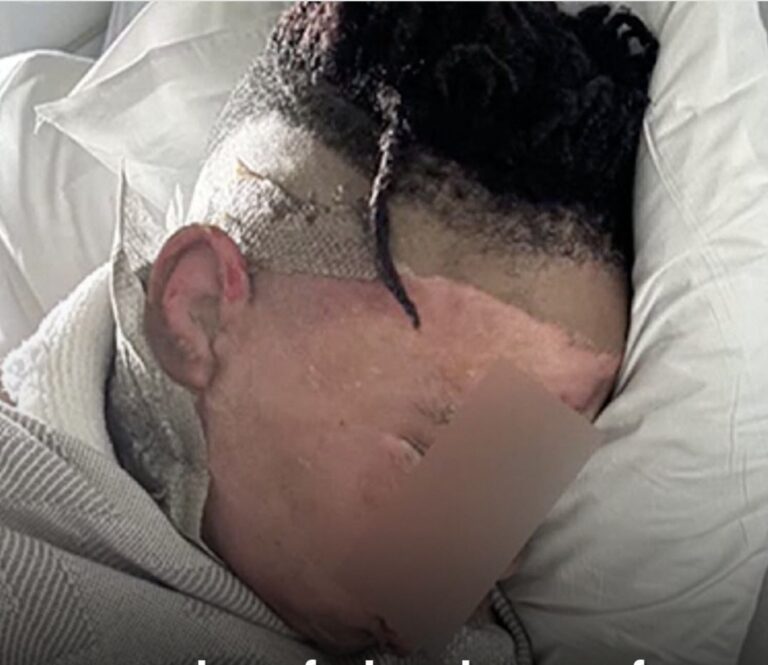 Georgia boy recovering after horrifying sleepover prank
