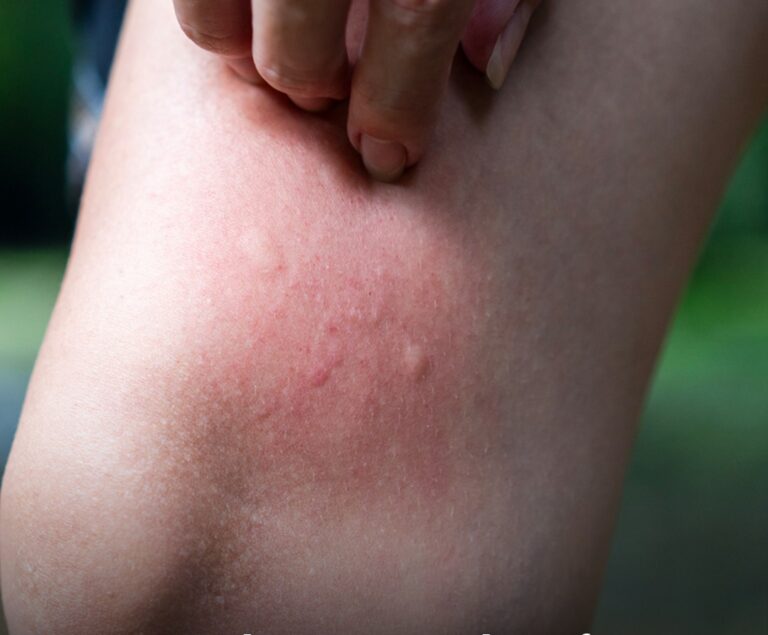 Mom, 33, issues warning after noticing ‘mosquito bite’ that turned out to be much more sinister