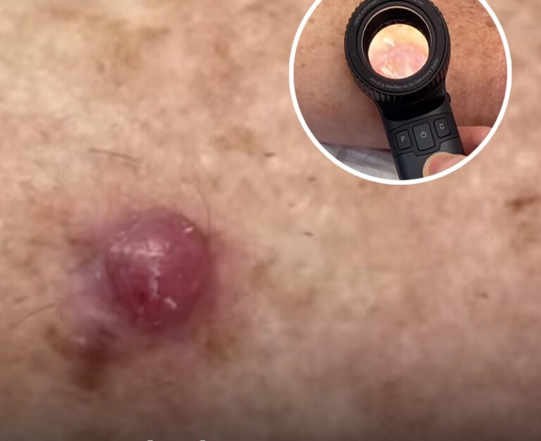 Seven simple ways to prevent skin cancer after doctor shares shocking video of ‘worst melanoma’ he’s ever seen