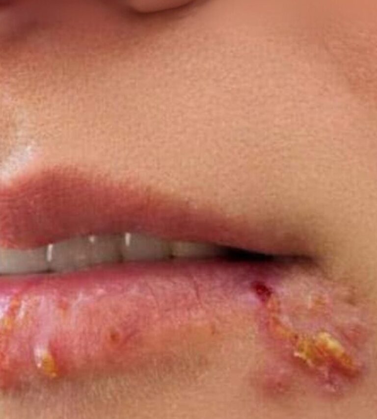 If you see this appearing on your lips, it is a sign of ca….