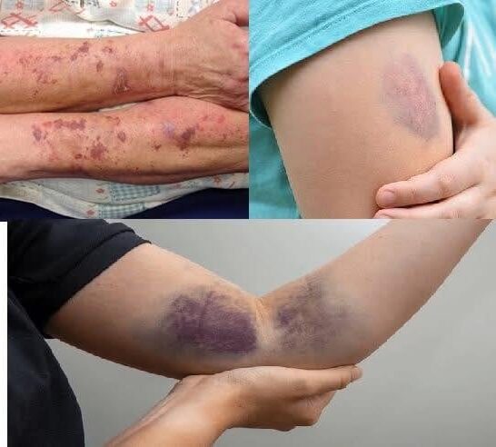 BE CAREFUL, if you get these bruises on your body, it means you have…
