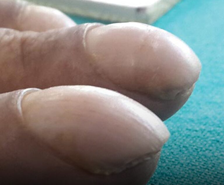 ‘Clubbing’ explained as major change to finger could be sign of deadly disease
