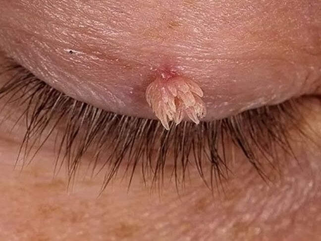 If you have papillomas on your neck or underarms, read this!