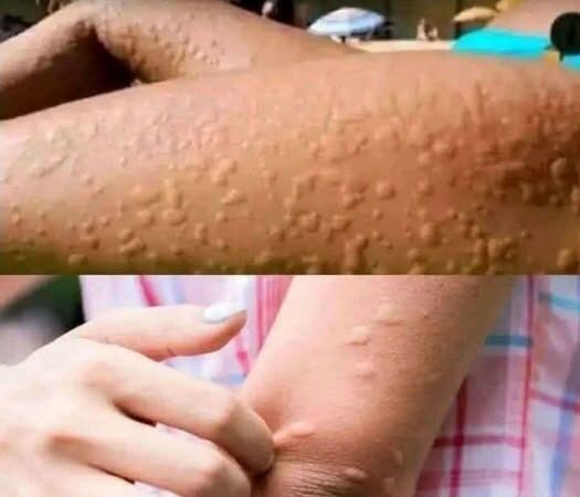BE CAREFUL, If you spot these dots on your skin, it means you have Ca…