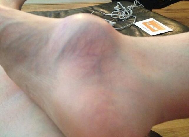Woman’s foot was swollen for years, then she finally pays the doctor a visit to learn why