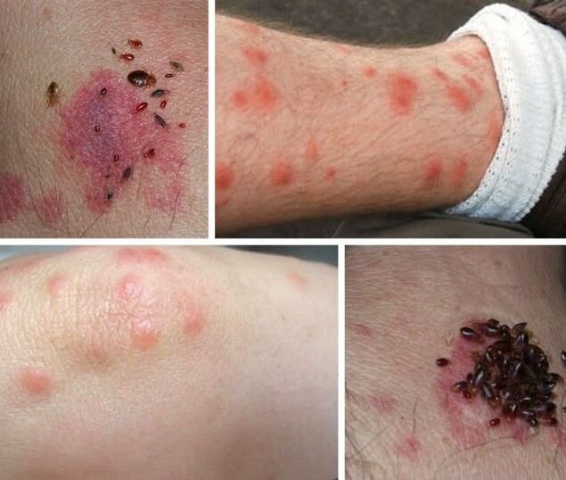 BE CAREFUL if you get these bruises on your body, it means you have Ca…