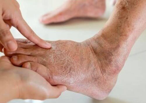 Diabetic foot: what it is and how to treat one of the most serious complications of diabetes