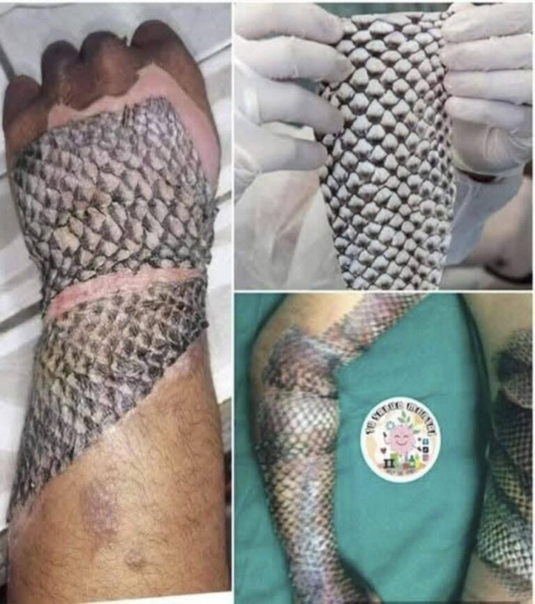 Tilapia Skin: An Innovative Alterna