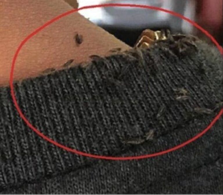 Man goes viral for extreme head lice infestation