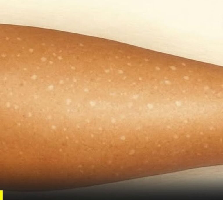 The Silent Signals On Our Skin What White Spots Reveal About Hidden Vitamin Deficiencies